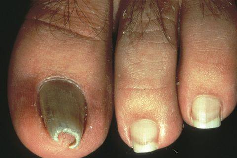 toenail separating #11