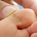 _plantar-foot-wart