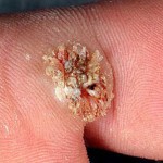 _plantar-wart