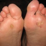 plantar-warts